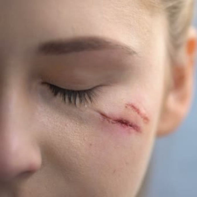 Scars